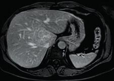 [36,55,56], iv) melhor visibilidade da cicatriz central na RM (hipointensa nas imagens ponderadas em T1 pré-contraste, muito hiperintensa nas imagens ponderadas em T2, e tornando-se hiperintensa na