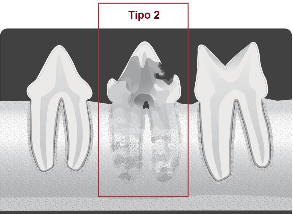 Revisão de literatura FMVZ USP [2016] Mariana Suemi Fugita 33 Tipo 2 (T2): estreitamento ou desaparecimento do espaço do ligamento periodontal em algumas áreas e diminuição da radiopacidade de parte