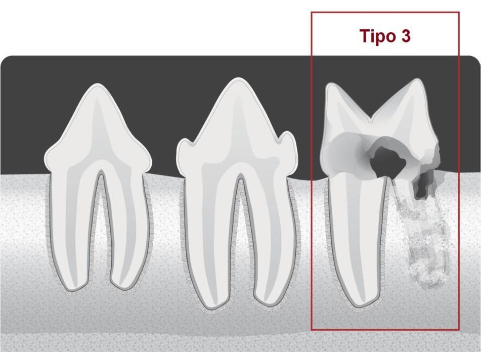 Revisão de literatura FMVZ USP [2016] Mariana Suemi Fugita 34 Figura 3 - Ilustração da lesão de reabsorção dentária tipo 3 (T3) Fonte: American Veterinary Dental College (AVDC) (2012) Ainda segundo o
