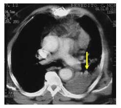 INTRODUÇÃO A úlcera penetrante de aorta é uma variante da dissecção aórtica clássica que apresenta características histopatológicas próprias 1.