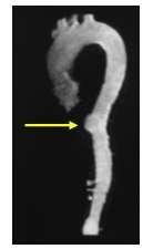 Sua progressão para a camada média pode resultar em hematoma intramural, formação de pseudoaneurisma, dissecção, ruptura ou embolização distal 2.