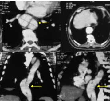 alterações relevantes detectáveis ao exame físico. A conclusão da última tomografia à qual o paciente havia sido submetido foi Controle pós-operatório de aneurisma de aorta torácica.