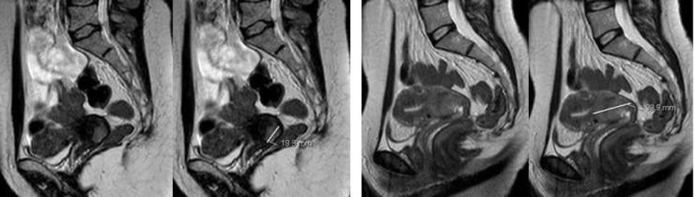 Fig. 1 - Determinação do maior diâmetro do tumor em duas doentes.