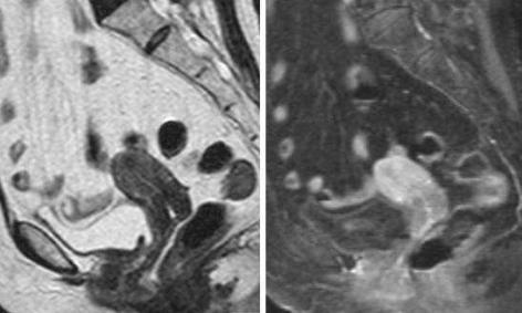 No segundo caso o tumor tem crescimento infiltrativo, com extensão ao istmo.