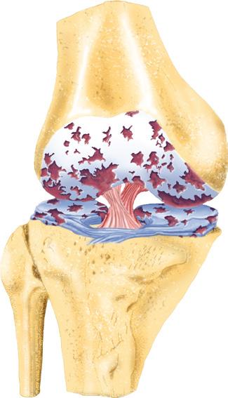 For knee dynamic needs Enquadramento na Osteoarthritis (OA) Membrana sinovial Membrana sinovial baixo peso molecular HA (LMW HA) Cartilagem alto peso molecular HA (HMW HA) Também conhecida como