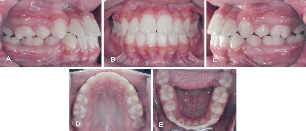 Houve controle do crescimento vertical dos maxilares com leve rotação anti-horária mandibular, e redução da altura facial anteroinferior.