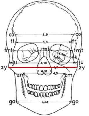 25 Figura 5 Marcos anatômicos da largura facial máxima (Bi-Zi). A linha vermelha representa a medida linear.