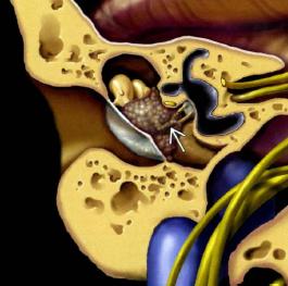 Colesteatoma congênito da orelha media Acumulo Hssular formada por resíduos de querahna RM com contraste é usada para fazer DDX com Glomo Hmpânico ou Schwannoma do nervo facial Massa de partes moles,