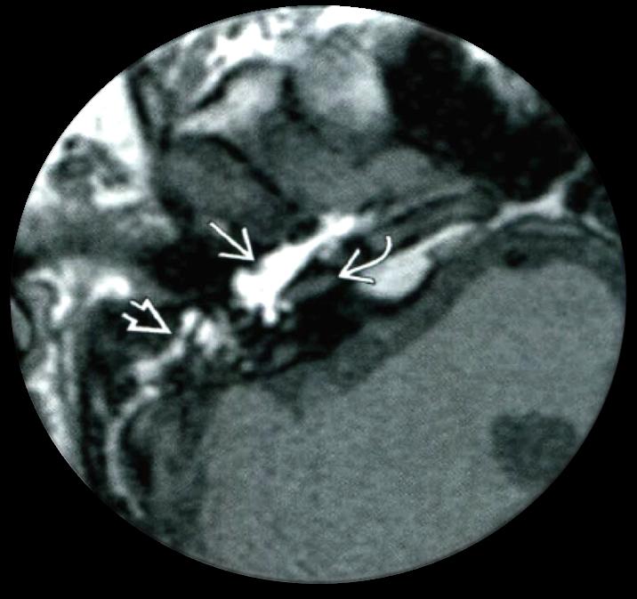 Granuloma de colesterol Tecido