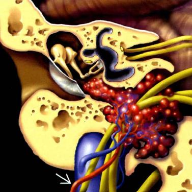 Paraganglioma dmpano jugular É um Paraganglioma que afeta a região do orifcio jugular e o ouvido médio RM T1 podemos ver áreas de alta sinal no seio do parênquima tumoral misturadas com focos