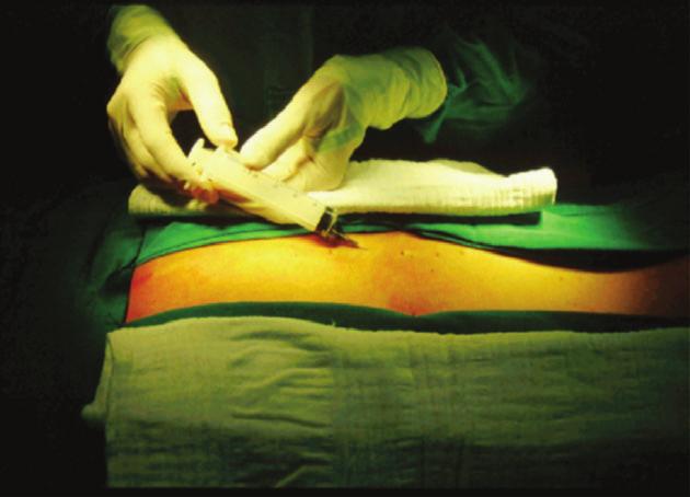 TRATAMENTO CIRÚRGICO DA ESCOLIOSE IDIOPÁTICA TÉCNICA CIRÚRGICA Estando o paciente sob anestesia geral, é feita a introdução da sonda vesical.
