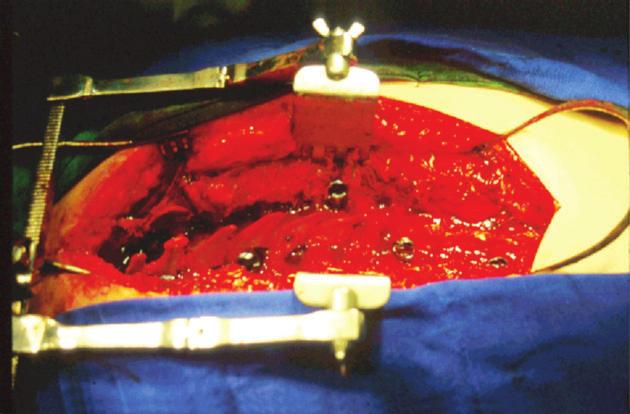 transversos. Rigorosa hemostasia deve ser realizada durante todo o procedimento (Figura 6).
