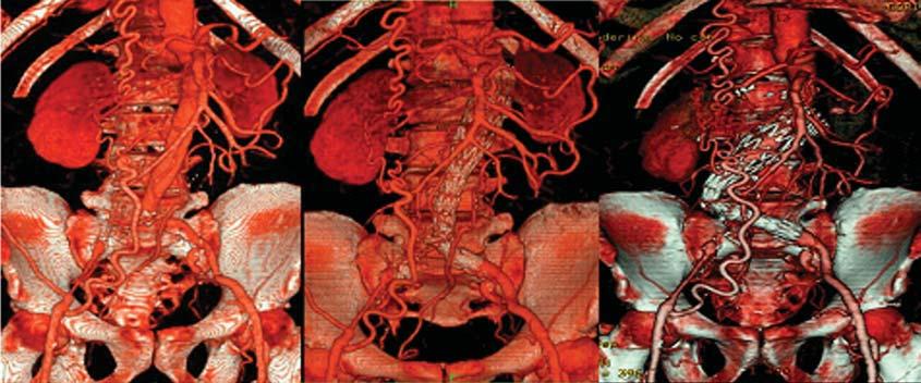 Thomaz F et al. indicações cirúrgicas. Durante muitos anos, o único tratamento foi a cirurgia aberta. Em 1969, Dotter (1) introduziu o conceito do tratamento endoluminal dos aneurismas da aorta.