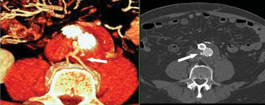 valiação pós-operatória de endoprótese da aorta abdominal (Figura 2), 30 do tipo II e um do tipo III (Figura 3). Destes 37 endoleaks, dois pacientes apresentaram mais de um tipo: os tipos I e II.