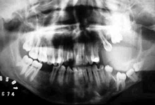 axiais do exame tomográfico computadorizado, evidenciando destruição óssea da maxila e da mandíbula do lado esquerdo Figura 5 - Exame tomográfico em