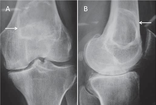 Há também achados compatíveis com artropatia degenerativa da articulação, que podem ser a causa da dor referida pelo paciente. Figura 1.
