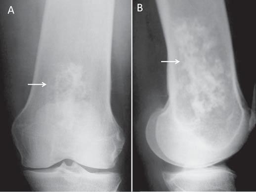 Identifica-se também cortical afilada em toda a extensão do fêmur avaliado.