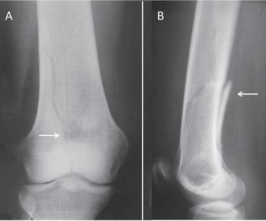 distal (seta), associada a traço de fratura metafisária (seta em B) centrada na lesão, com extensão articular, caracterizando uma fratura em osso patológico. Figura 5.