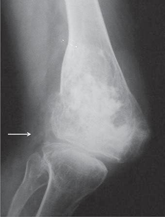 A lesão rompe a cortical, com calcificação também em partes moles (seta). Figura 7. A: Jovem de 10 anos de idade, com dor progressiva e aumento de volume no joelho direito.