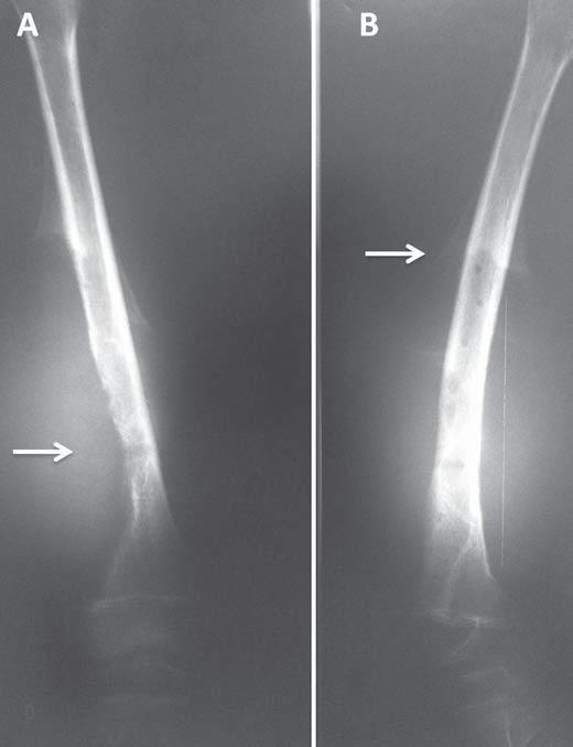 Figura 11. Paciente de 50 anos de idade, com dor no joelho e achados radiológicos de lesão agressiva.