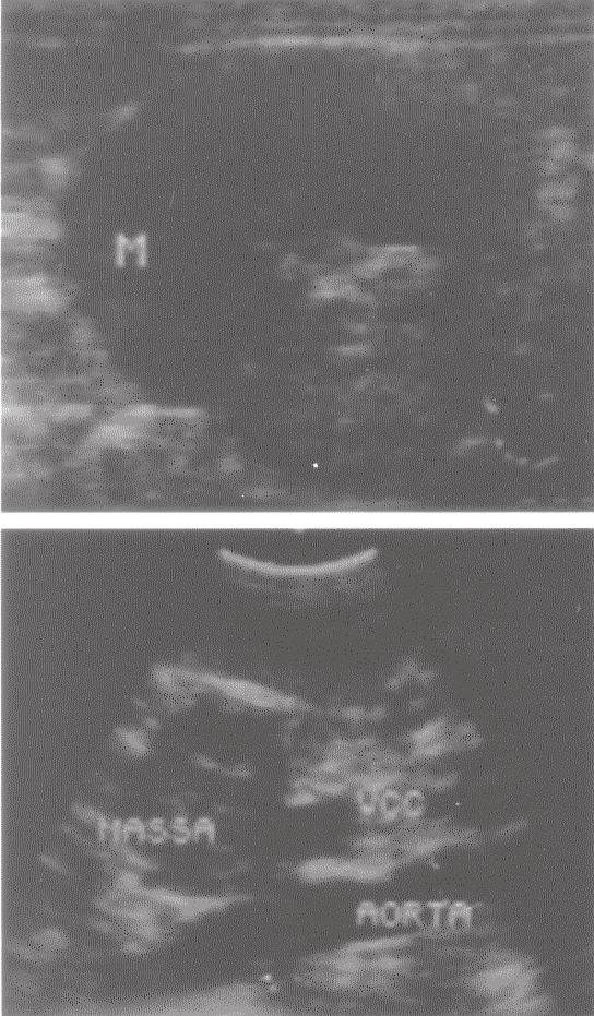 relatadas em literatura. Os exames radiográficos e ultrasonográficos no paciente deste relato descartaram as possibilidades de metástases detectáveis em tórax e em órgãos da cavidade abdominal.