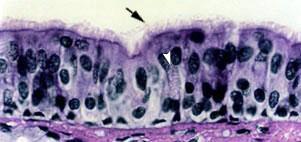 3 - Corte da traqueia, mostrando o muco sobre a superfície luminal, o epitélio pseudoestratificado colunar ciliado com células caliciformes, o tecido conjuntivo com
