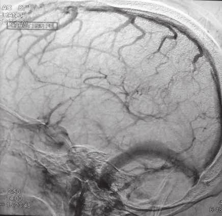 Figura 2. Angiograia cerebral revela falha de enchimento da veia de Labbé esquerda, sugestivo de trombose. Figura 3.