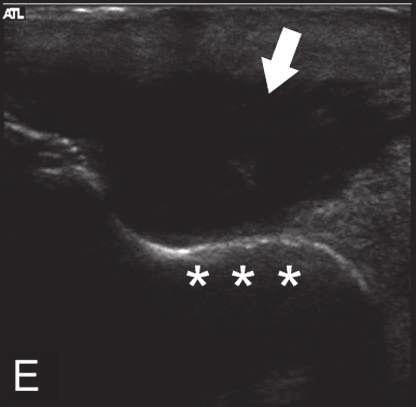 Comumente há espessamento sinovial e hiperemia periarticular conco- mitantes (Fig. 3).