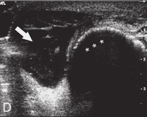 O aspecto ultra-sonográfico é idêntico ao das demais bursites, associando-se à caracterização de coágulos ou depósitos cristalinos intrabursais.