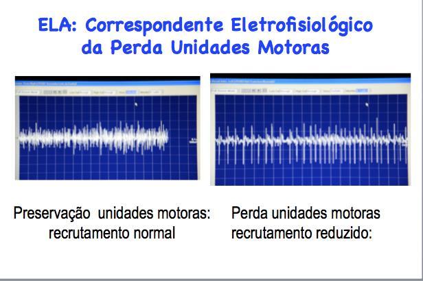 A eletromiografia ou exame de agulha Uma das partes importantes da ENMG é a eletromiografia ou exame de agulha. Nesse exame são inseridas agulhas que funcionam como eletrodos nos músculos.