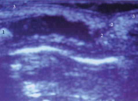 Ultra-sonografia sagital sacral: 1) cauda equina; 2) corpo vertebral;