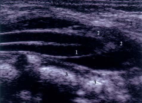 Arq Neuropsiquiatr 2004;62(3-A) 705 Fig 7. Ultra-sonografia sagital lombar.