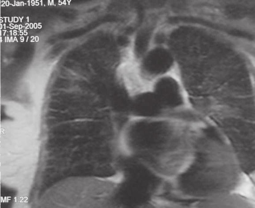 6 RMN torácica TSE T2: corte coronal com