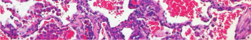 7 (A, B, C, D) Surgical lung biopsy histology study showed intravascular infiltration by large lymphatic