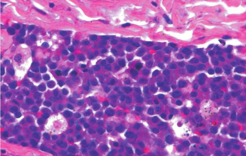 starry-sky pattern, LCA, CD20 (D), CD10 and CD5 immunoreactivity, CD3, cyclin D1 and AE1/AE3 negative;