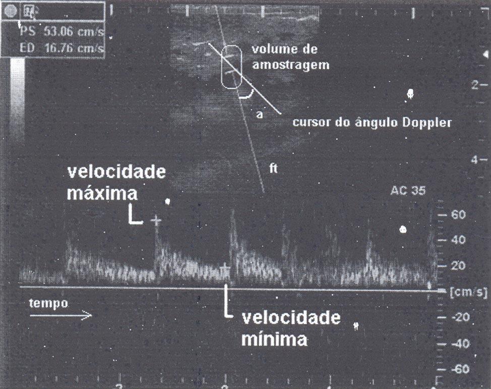 Princípios físicos do Doppler em ultra-sonografia. 873 refletidas quando o objeto (corpo) refletor se move em relação a uma fonte de onda sonora.