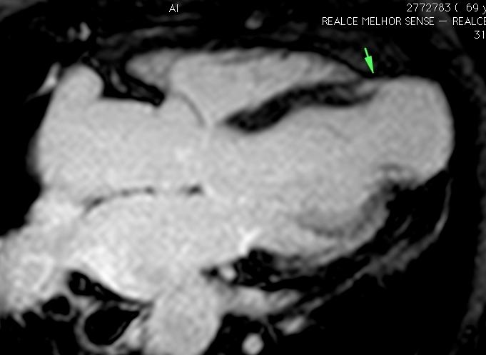 CC-CD = cardiopatia chagásica com disfunção sistólica do ventrículo esquerdo.