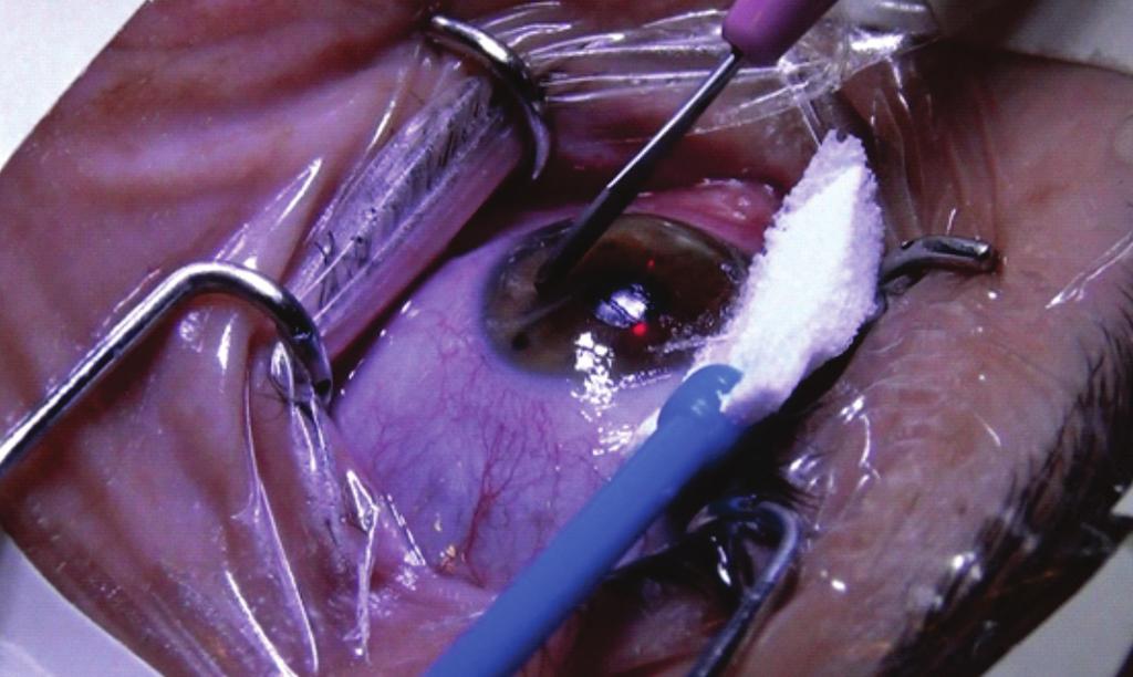 Estudo comparativo entre a técnica manual e a escova rotatória na remoção do epitélio corneano na ceratectomia fotorrefrativa (PRK) 139 INTRODUÇÃO Aera moderna da cirurgia refrativa teve início em