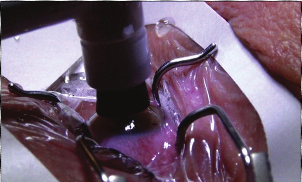 A ceratectomia fotorrefrativa (PRK Photorefractive Keratectomy), uma das técnicas mais populares e efetivas para a correção das ametropias, consiste na ablação a laser da superfície anterior do