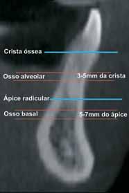 Borges MS, Mucha JN FIGURA 1 - Imagem transversal de corte tomográfico computadorizado, ilustrando a localização da crista óssea e dos ápices radiculares, bem como a determinação das áreas medidas,
