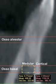 FIGURA 3 - Vista ampliada de corte de TC na região entre 1 e 2 na mandíbula, com a ilustração da medição da densidade óssea na faixa de osso basal, tanto da cortical vestibular como da área medular.