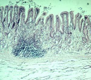 Nódulos linfáticos agregados de tecido linfoide acúmulos