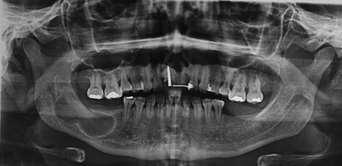 Quando o cisto radicular permanece após a perda do dente afetado recebe o nome de cisto residual 1.