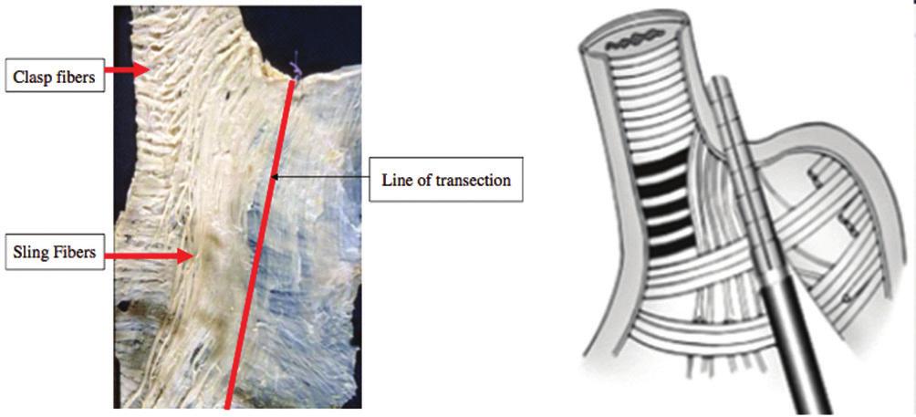 Artigo de Revisão FIGURA 5 Disposição das fibras na camada muscular do complexo anatômico esofagogástrico: A) dissecção cadavérica com traçado da linha de grampeamento; B) desenho esquemático do