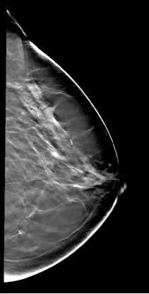 DIGITALIZAÇÃO DA MAMOGRAFIA ANALÓGICA É MUITO DIFÍCIL A mamografia é uma técnica que exige altissmia resolução espacial na imagem A digitalização necessariamente reduz a resolução espacial da imagem