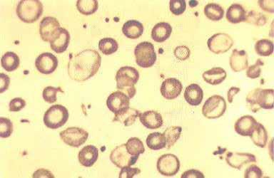 20 As talassemias também constituem um grupo de anemias, também de ordem hereditária decorrente de mutações que afetam a síntese de hemoglobina.