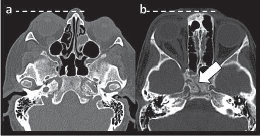 Figura 2. Tomografia computadorizada com contraste, fase arterial. Paciente do sexo feminino, 73 anos, com diagnóstico de FDSC.