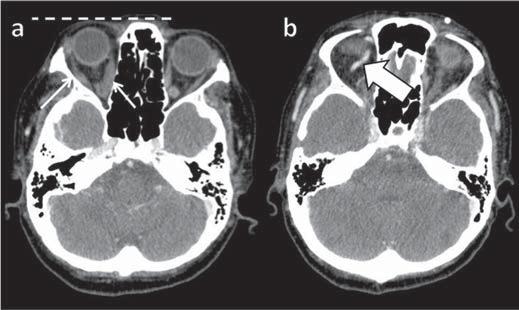 b: Contrastação precoce da VOS direita, que se apresenta discretamente ectasiada (seta grossa). Figura 3. Tomografia computadorizada, janela óssea.