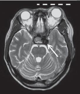 A presença de fratura na base do crânio sugere origem pós-traumática no paciente da imagem b. Figura 4. Ressonância magnética de encéfalo.