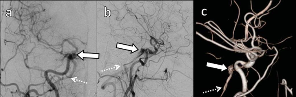 na maioria dos pacientes com FDSC. Nas sequências ponderadas em T2 pode-se identificar a drenagem venosa cortical anormal para veias leptomeníngeas e possíveis tromboses (12).